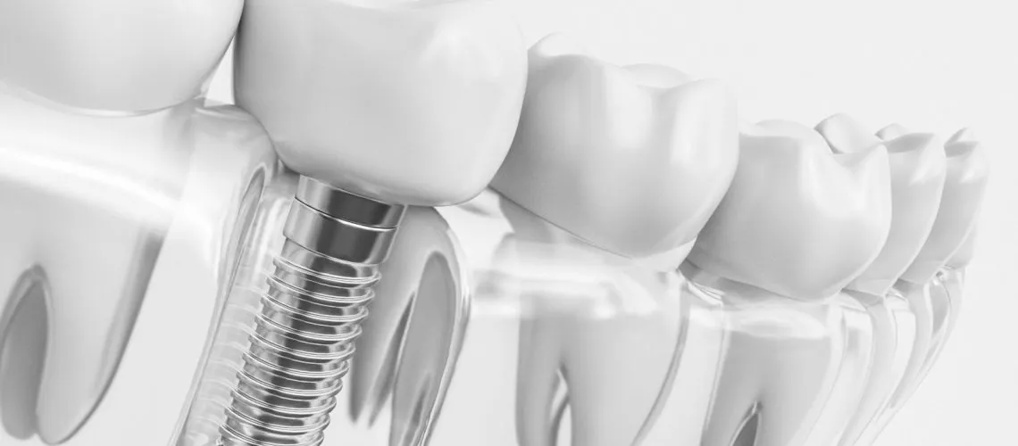 Are Dental Implants Noticeable?
