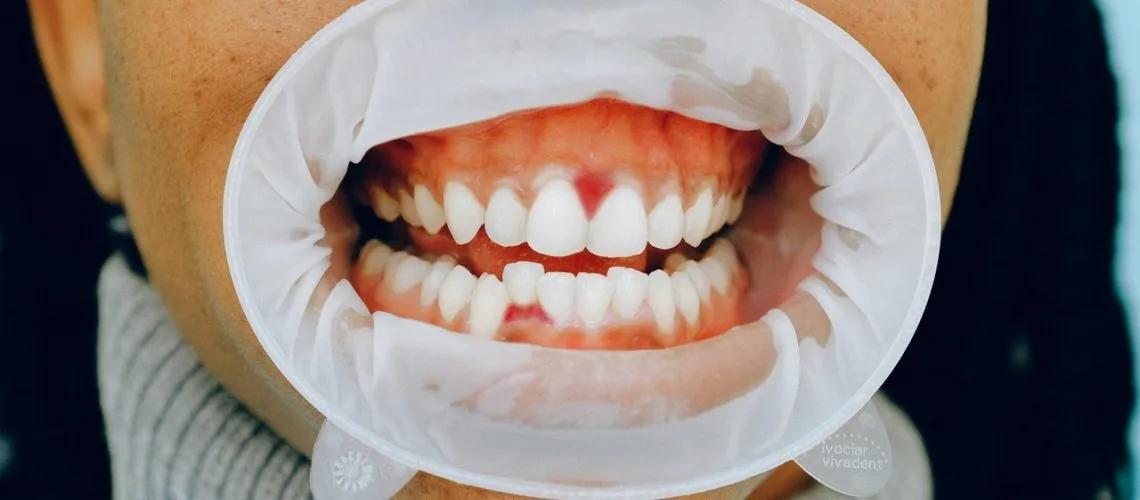 How Long Does It Take For a Tooth Infection to Spread?