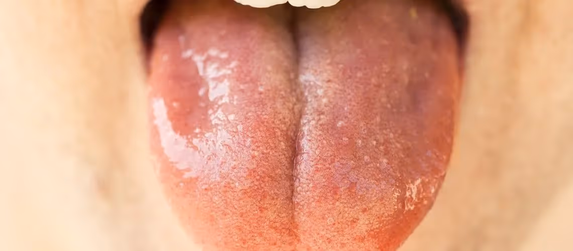Can a Dry Mouth Cause Cavities?