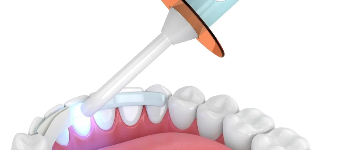 Is Dental Bonding Permanent?