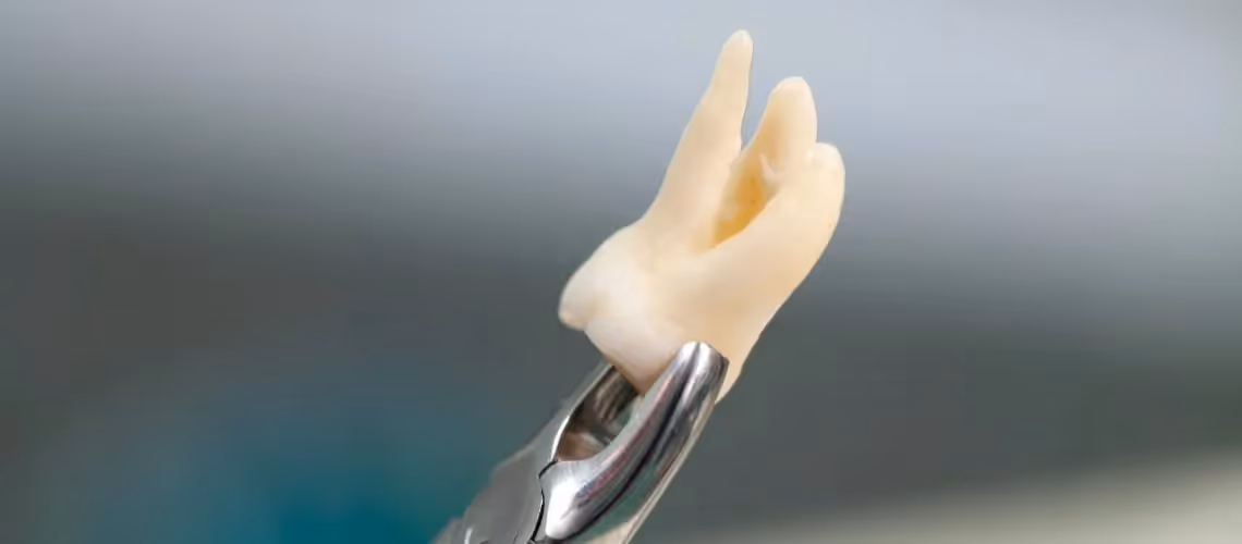 How Long is Wisdom Teeth Recovery?