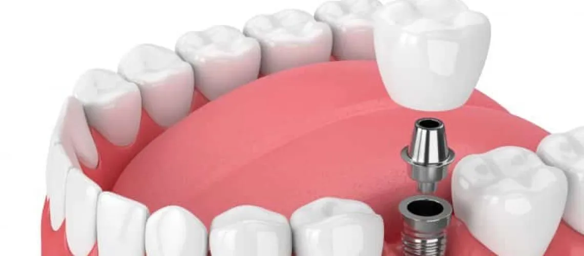 Unveiling the Harmony: Dental Implants and Jawbone 
