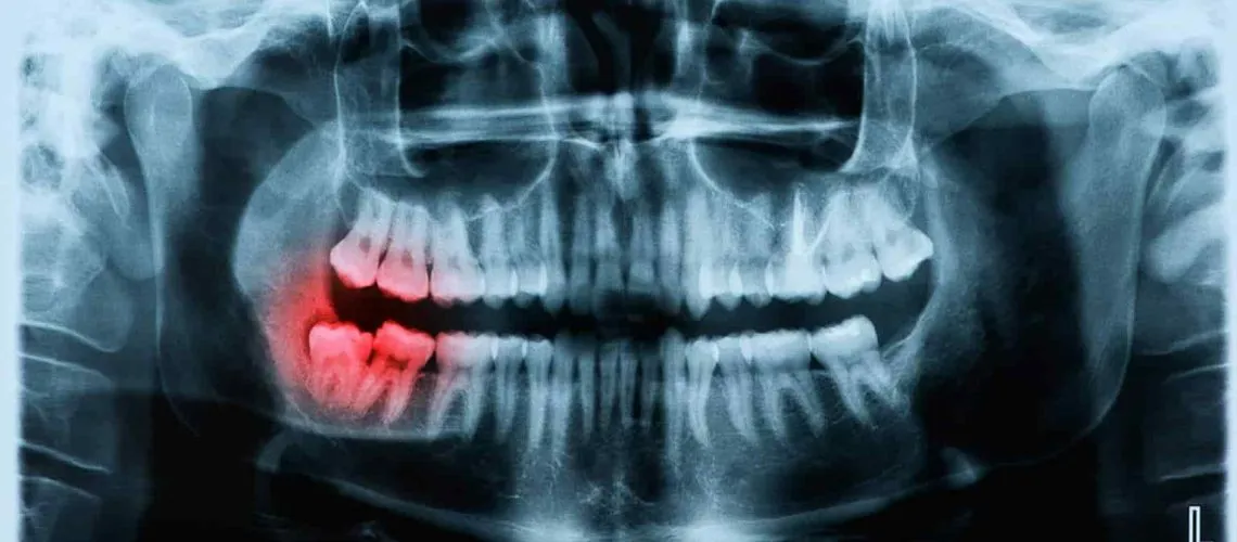Navigating Wisdom Teeth Extractions for Teens: A Comprehensive Guide