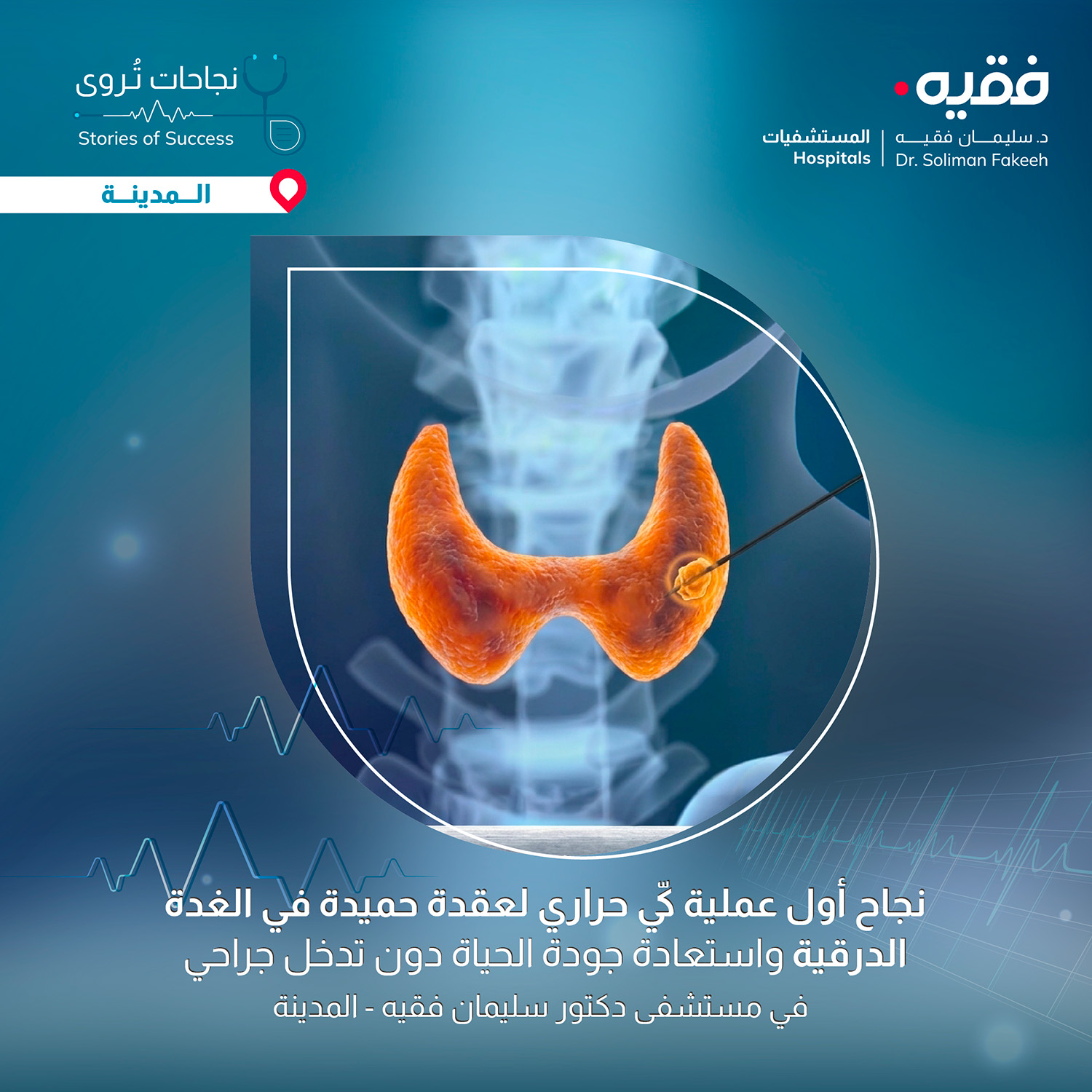 نجح فريق طبي في مستشفى د. سليمان فقيه – المدينة المنورة في إجراء عملية كيّ حراري موجّه بالأشعة لعقدة حميدة في الغدة الدرقية، لمريضة في العقد الثاني من عمرها، كانت تعاني من انتفاخ في الرقبة منذ ستة أشهر، تسبب لها في صعوبة البلع وأثّر على جودة حياتها.