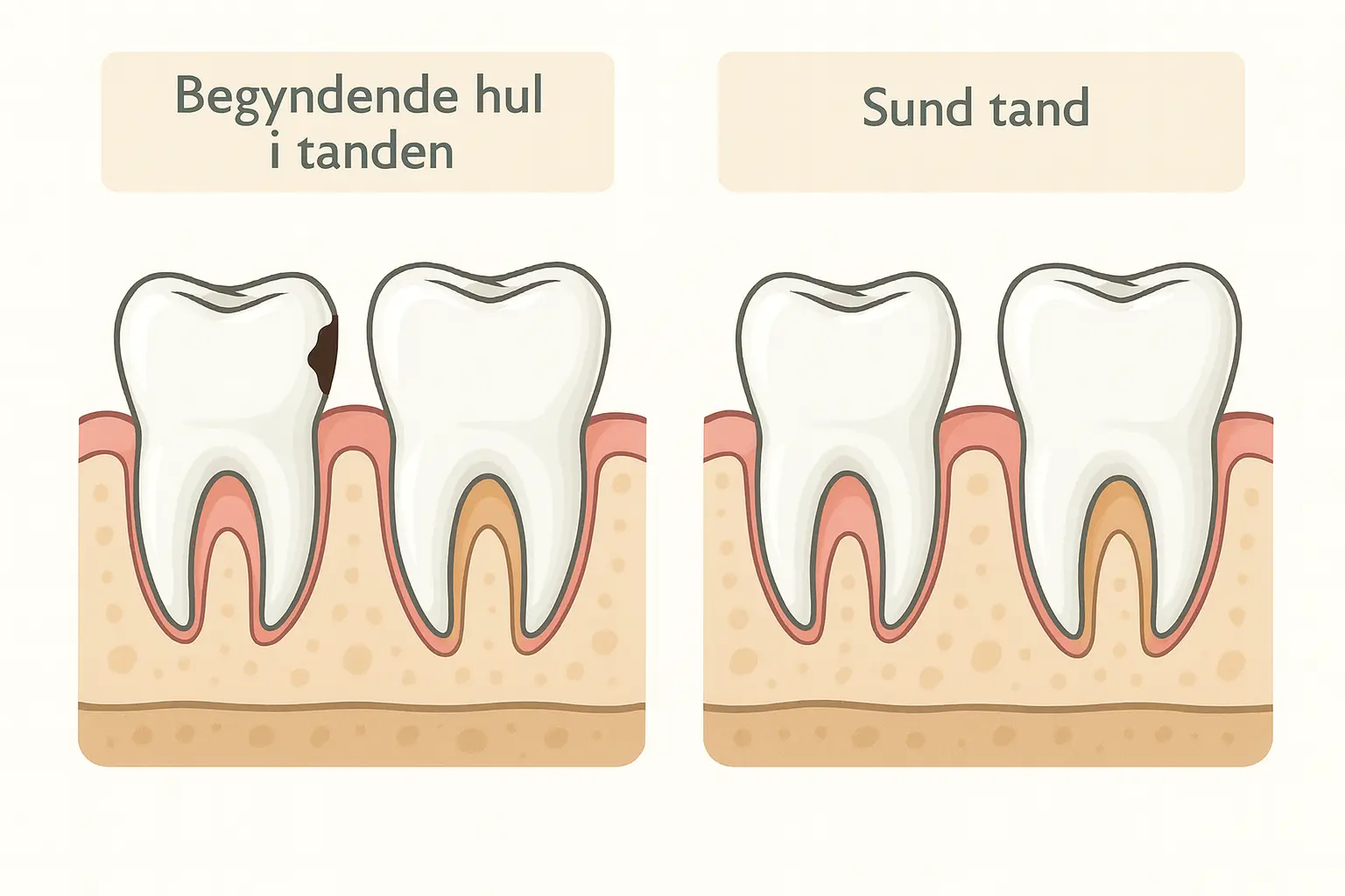 Begyndende hul i tanden – tegn, forebyggelse og behandling