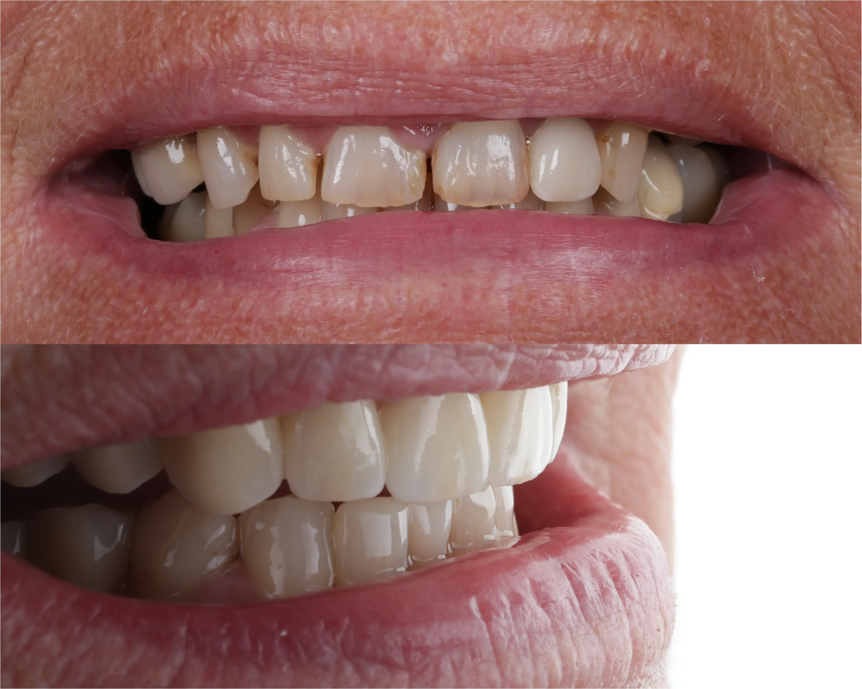 Hjælp til forbedret tyggeevne