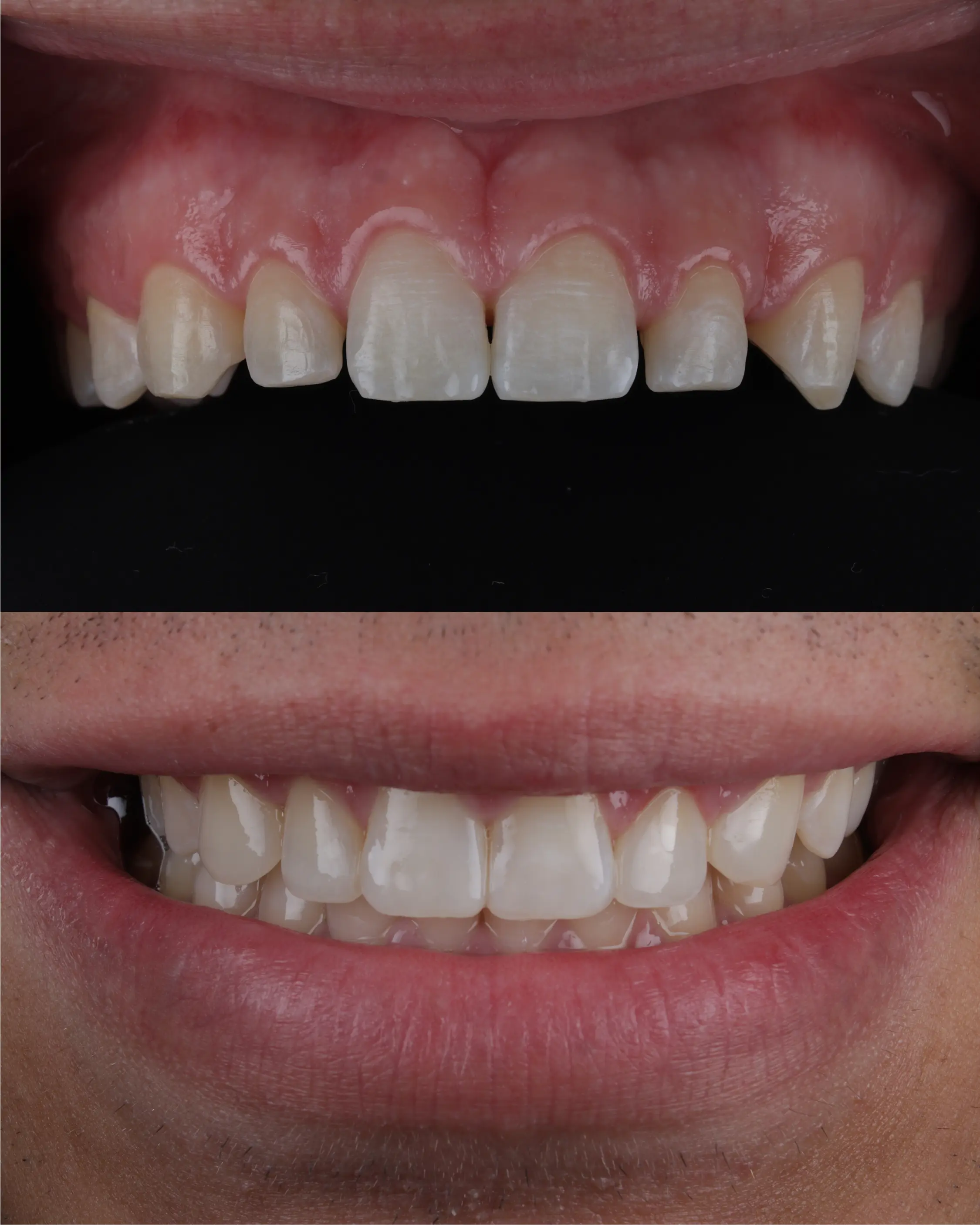 Kosmetisk forbedring af tandsæt