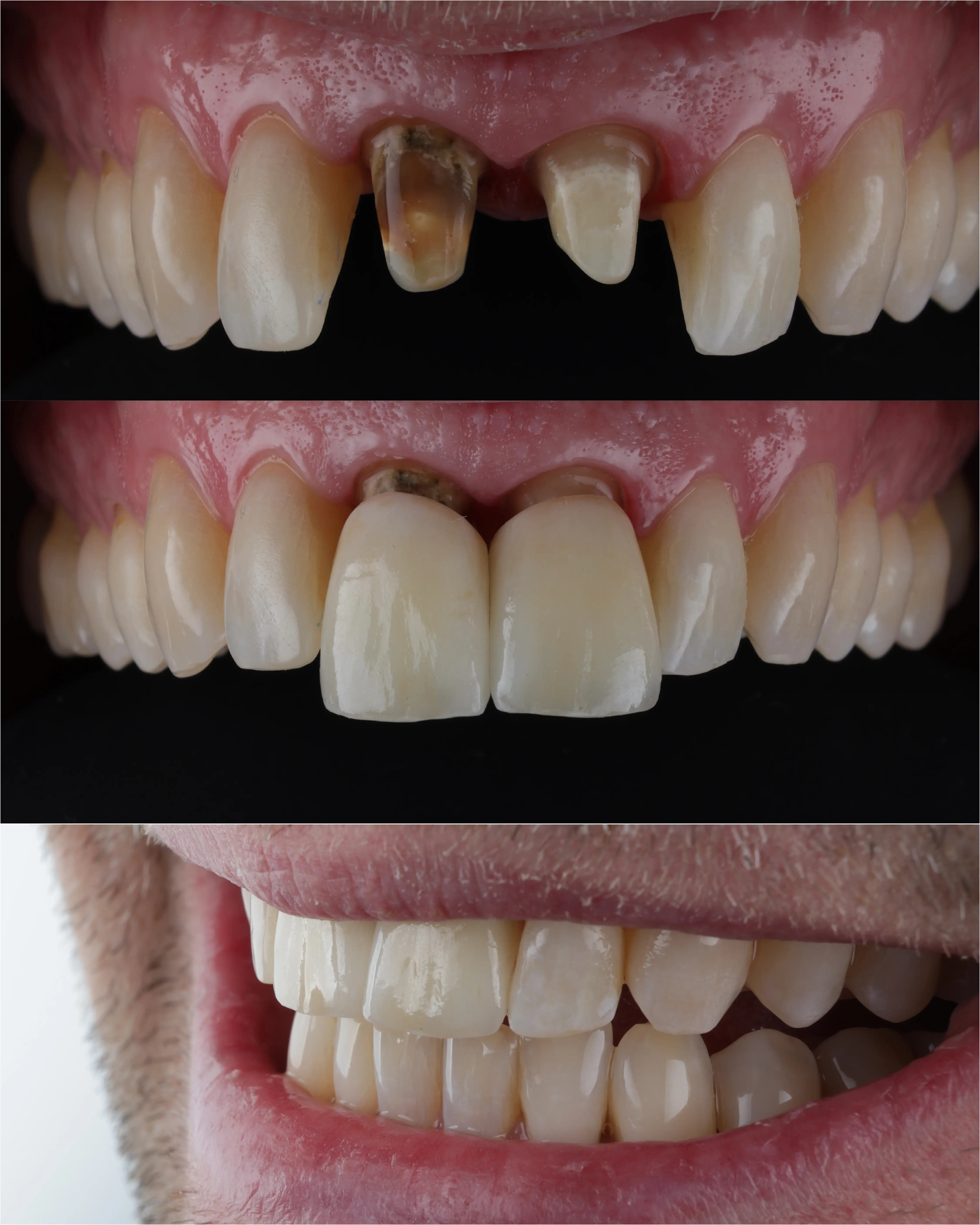 Udskiftning af gamle tandkroner