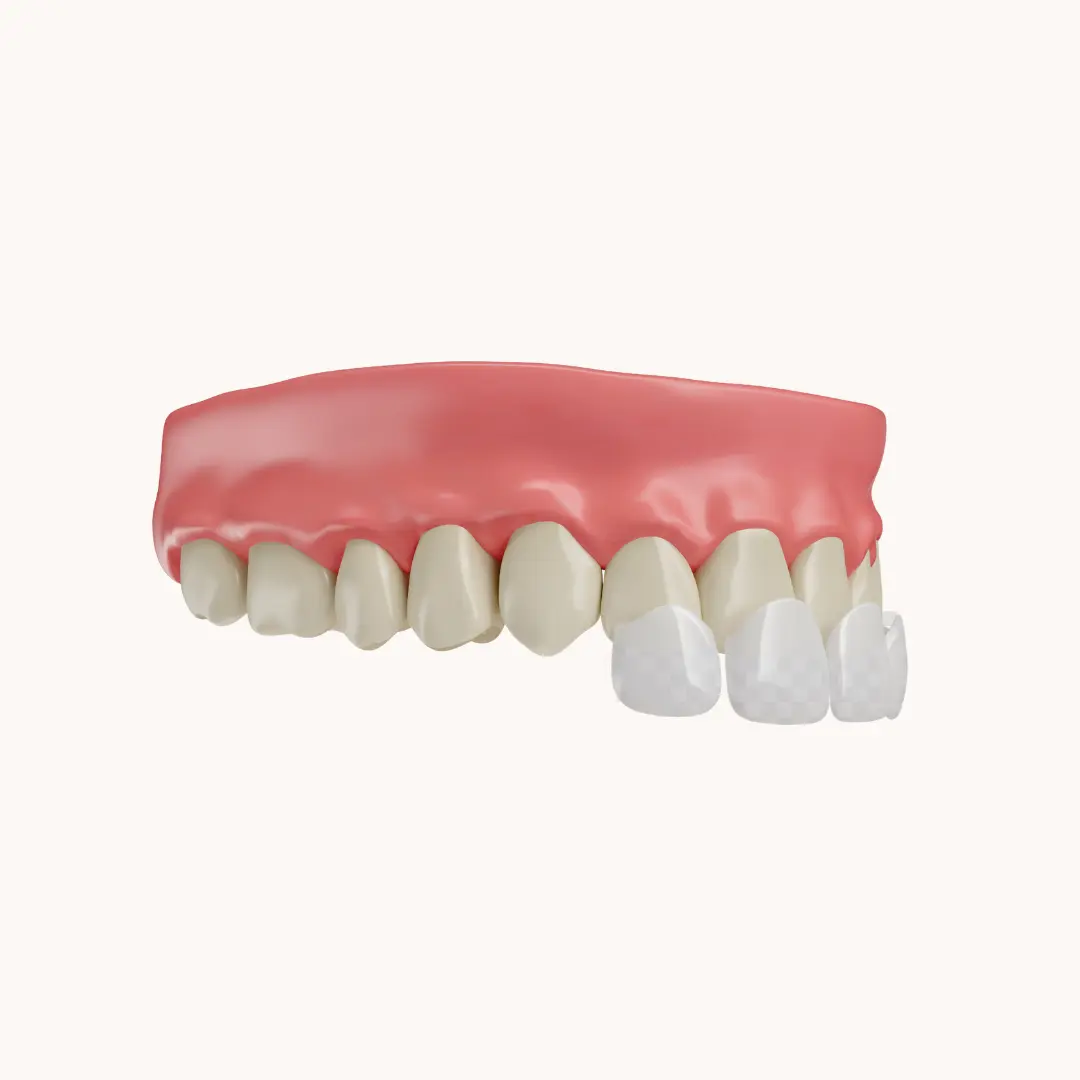 Hvad er porcelænsfacader (veneers)? 