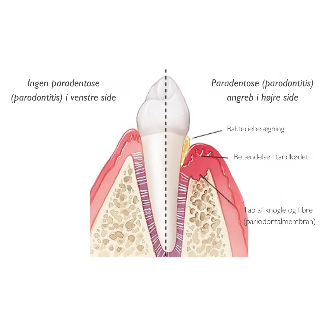 Symptomer på paradentose (parodontitis)