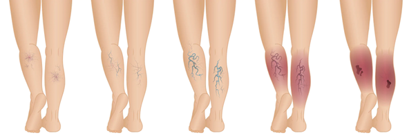 Stages of chronic venous disease from spider veins to ulcers