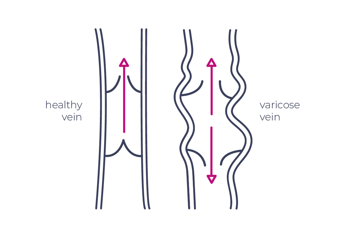Effect of HIFU ultrasound on a varicose vein