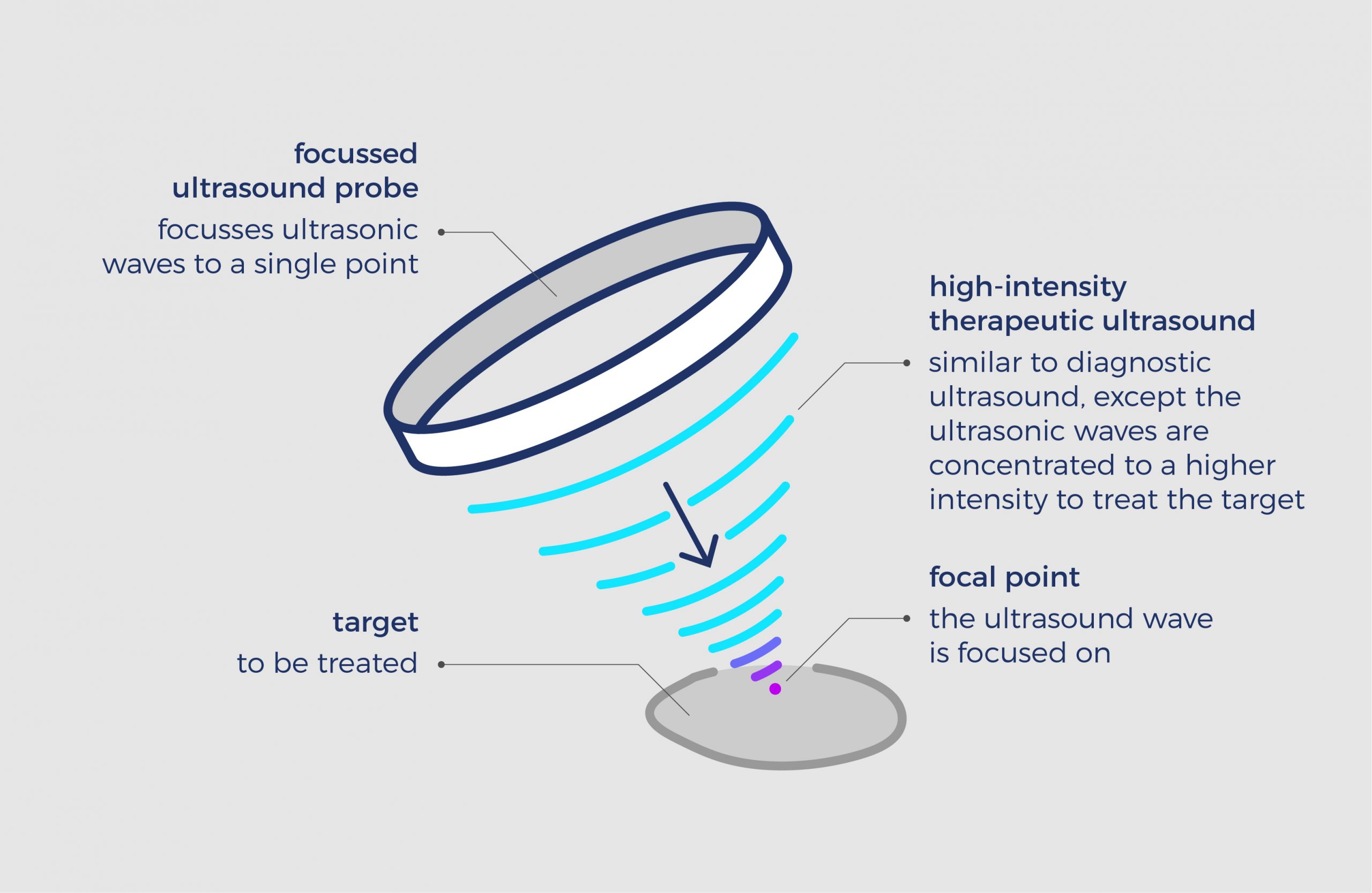 How HIFU echotherapy works