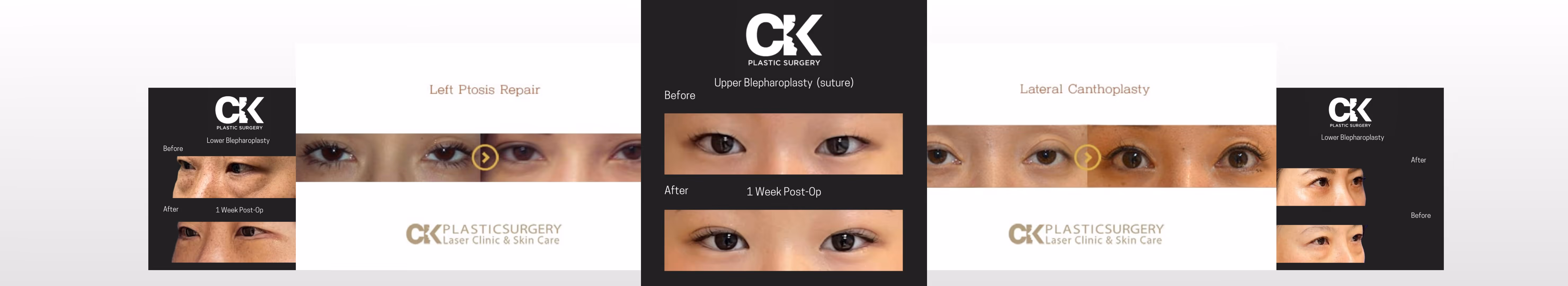 Before and After images of plastic surgery in Los Angeles CK Plastic Surgery Dr Kim