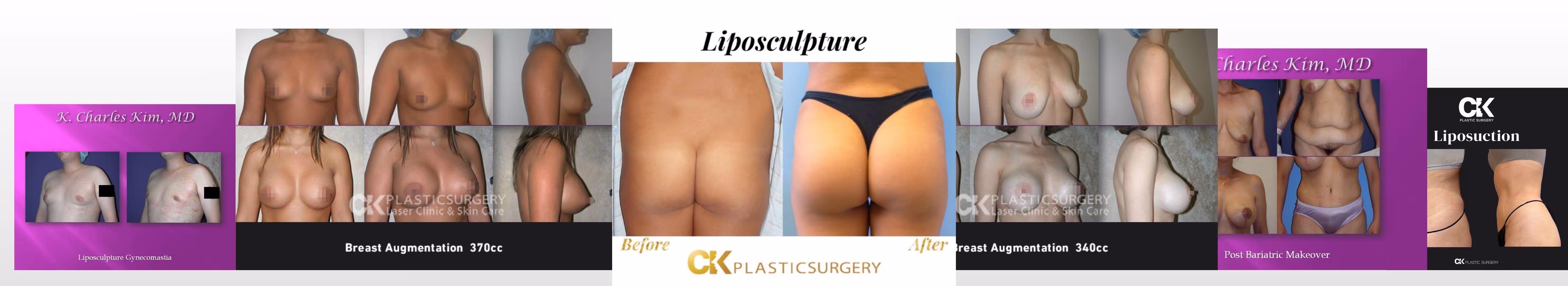 Doctor Charles Kim Plastic Surgeon the best breast augmentation and facelift procedure.