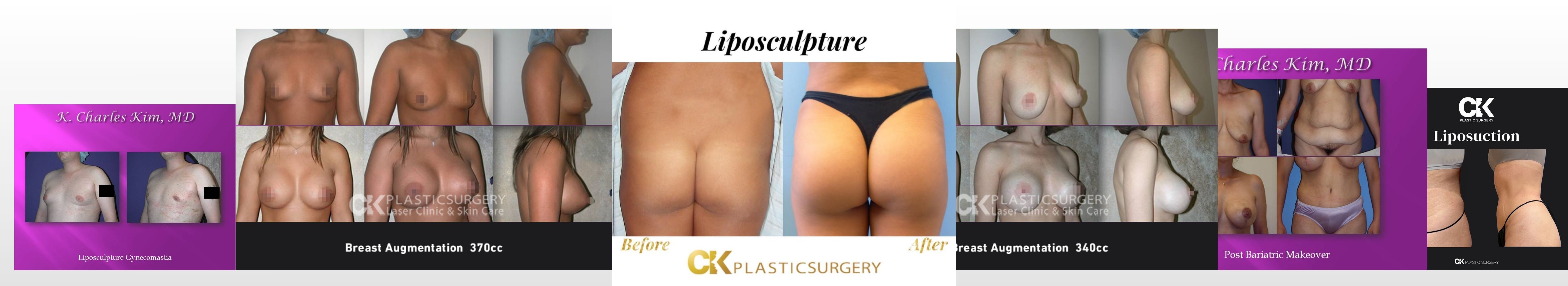 Doctor Charles Kim Plastic Surgeon the best breast augmentation and facelift procedure.
