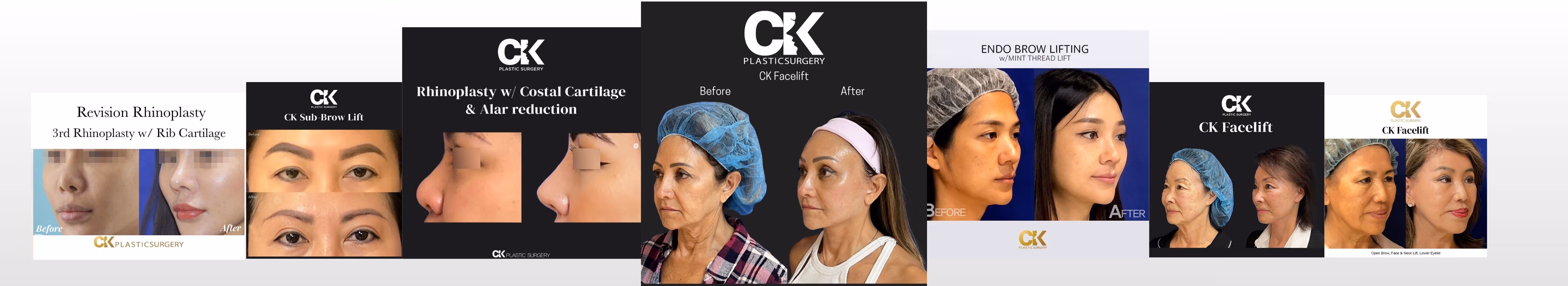 Before and After images of plastic surgery in Los Angeles CK Plastic Surgery Dr Kim