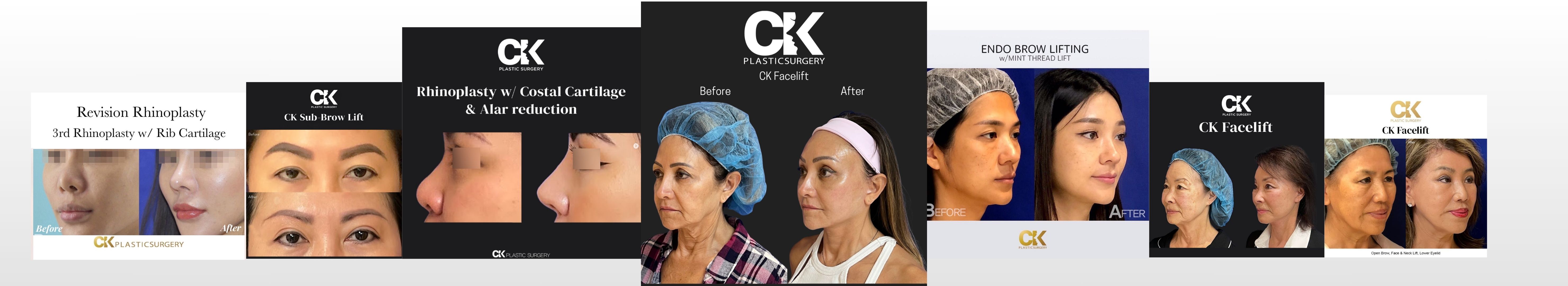 Before and After images of plastic surgery in Los Angeles CK Plastic Surgery Dr Kim