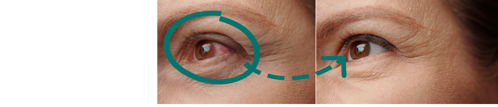 Eye-area images with a turquoise circle and dashed arrow highlighting the eyelids