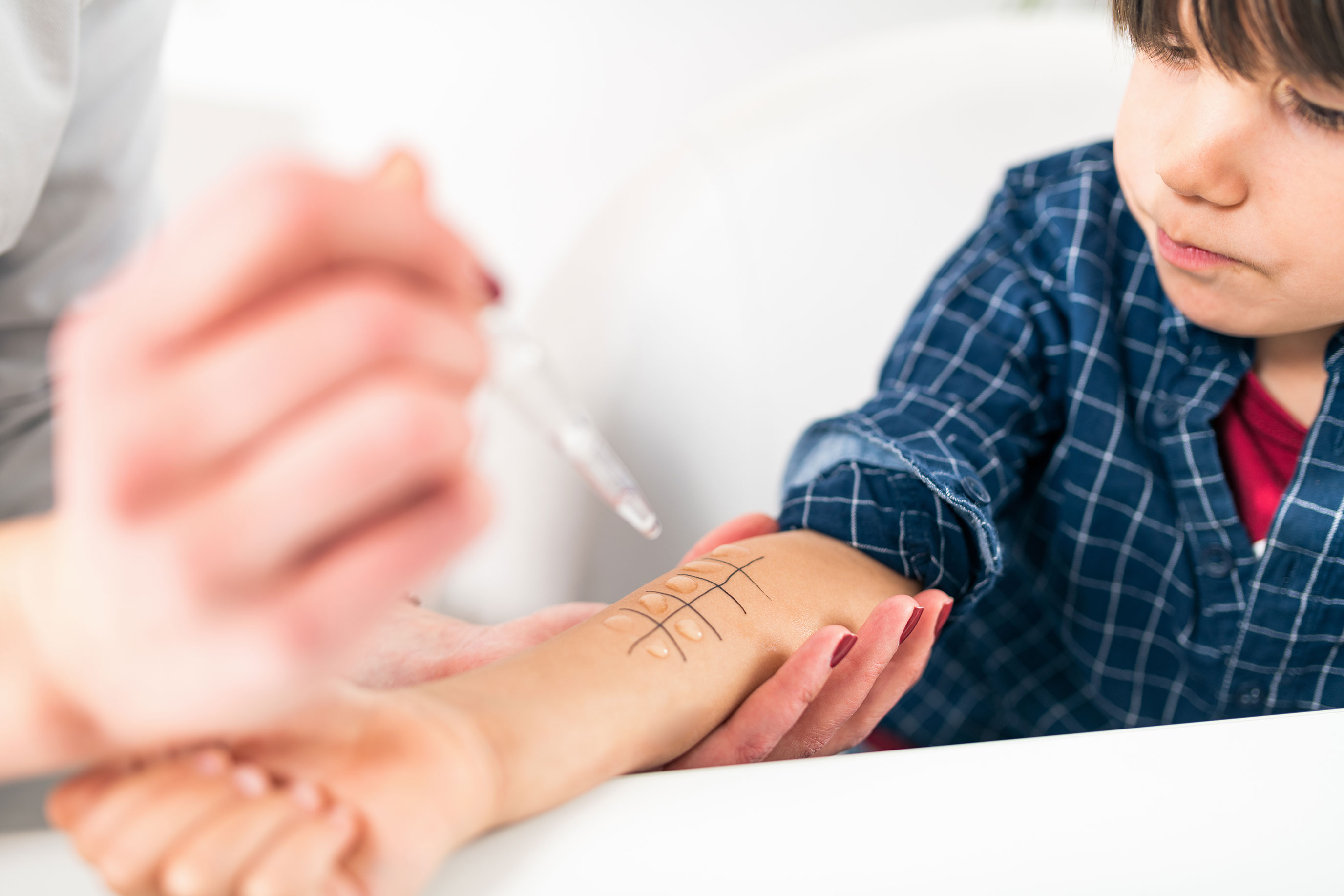 A close-up of a child’s arm being tested for allergies using a grid of drops on the skin and skin prick testing.