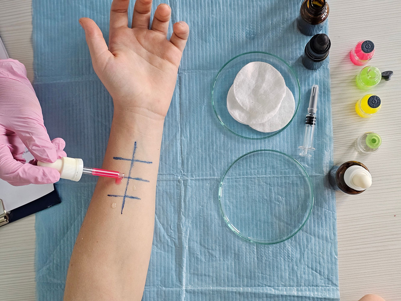 Close-up of a child’s forearm during a skin prick allergy test with marked grid and drops being applied