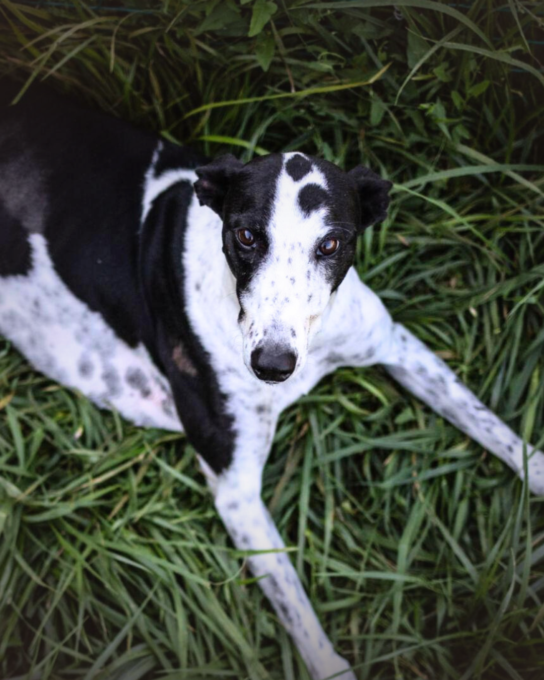 Bone Cancer (Osteosarcoma)