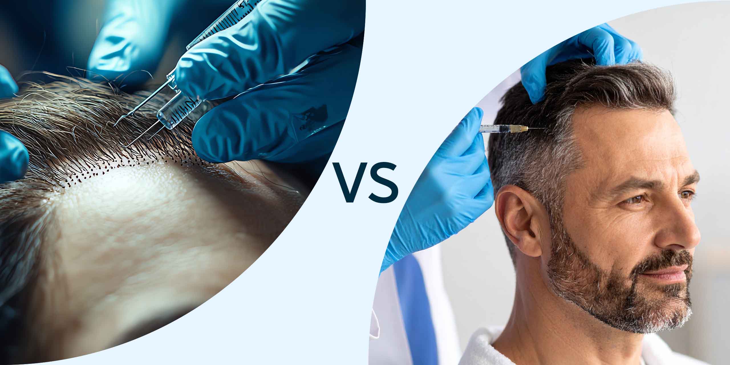 Vergleich Haartransplantation und PRP Anwendung. links Haartransplantation gegenüber PRP von einem Mann mit einer Spritze