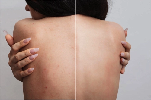 before and after treatment for back acne in Tucson Arizona