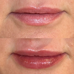 lip augmentation using dermal fillers in Tucson