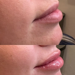 before and after dermal fillers in Tucson Arizona for lips