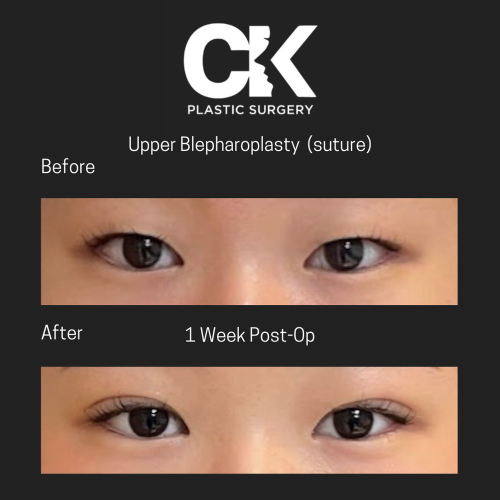 Before and after upper blepharoplasty in Los Angeles, showing removal of hooded eyelid skin for a more open eye
