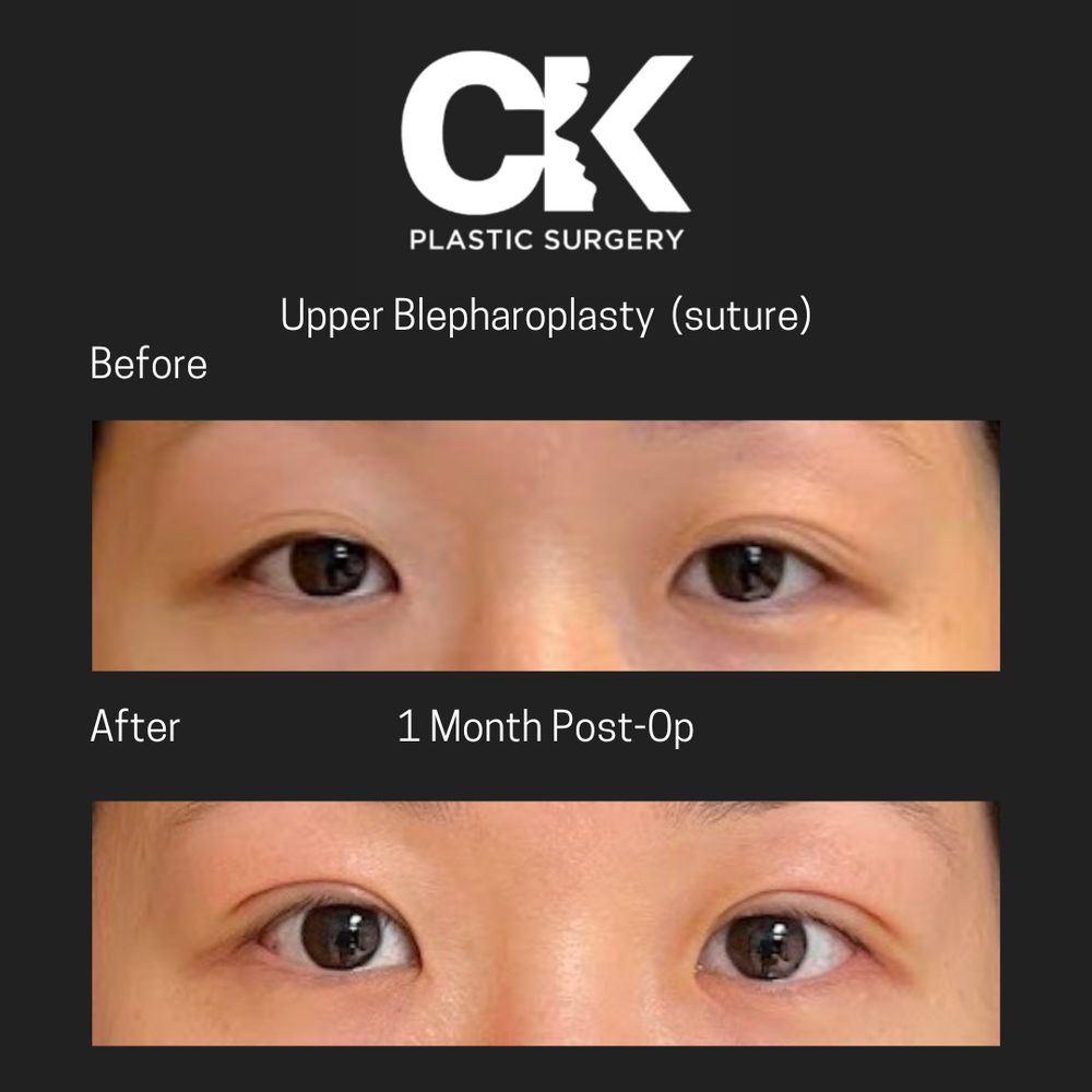 Patient's eyes before and after upper eyelid surgery for sagging skin in Southern California