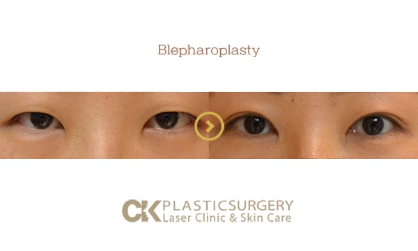 Before and after upper blepharoplasty in Los Angeles, showing removal of hooded eyelid skin for a more open eye