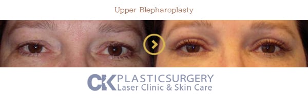 Before and after upper blepharoplasty in Los Angeles, showing removal of hooded eyelid skin for a more open eye