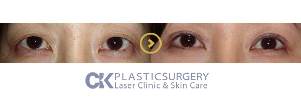 Before and after upper blepharoplasty in Los Angeles, showing removal of hooded eyelid skin for a more open eye