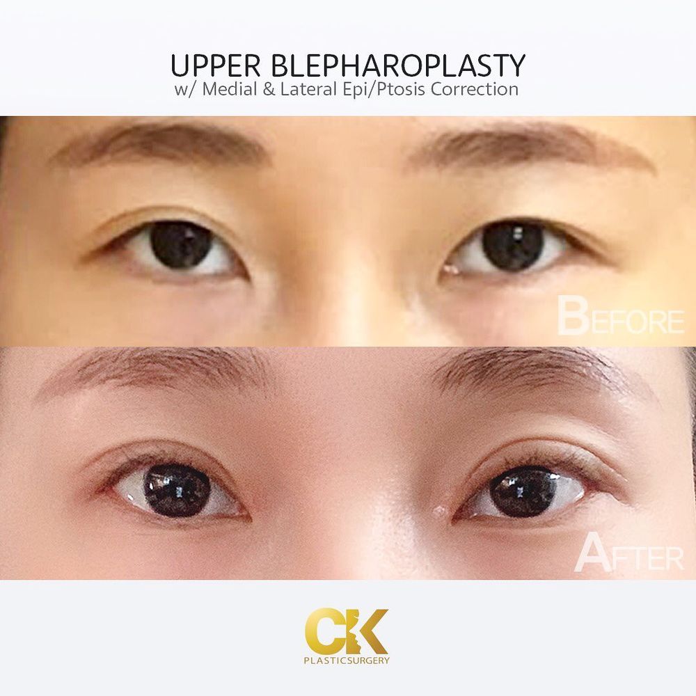 Before and after upper blepharoplasty in Los Angeles, showing removal of hooded eyelid skin for a more open eye
