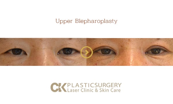 Before and after upper blepharoplasty in Los Angeles, showing removal of hooded eyelid skin for a more open eye