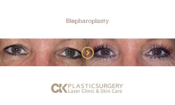 Patient's eyes before and after upper eyelid surgery for sagging skin in Southern California