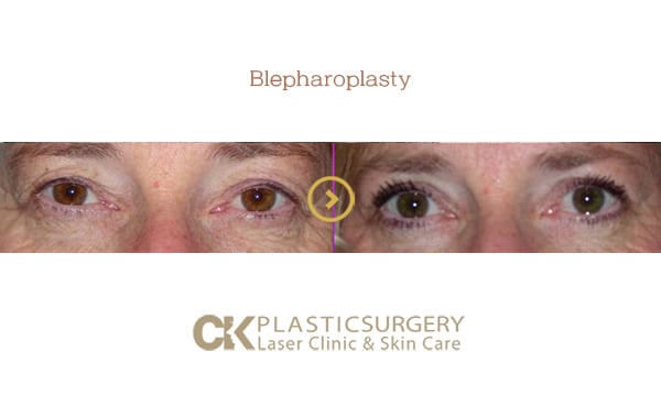Before and after upper blepharoplasty in Los Angeles, showing removal of hooded eyelid skin for a more open eye