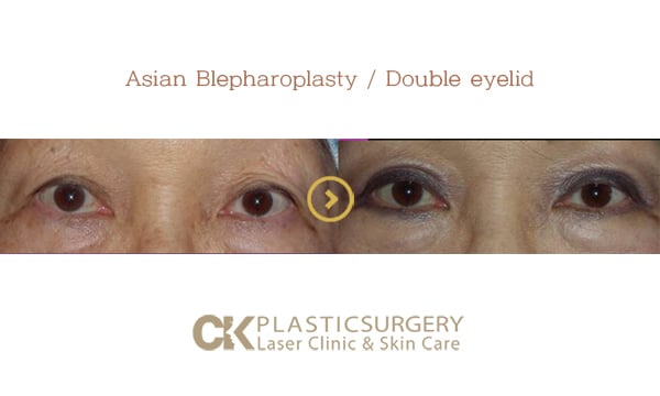 Patient's eyes before and after upper eyelid surgery for sagging skin in Southern California