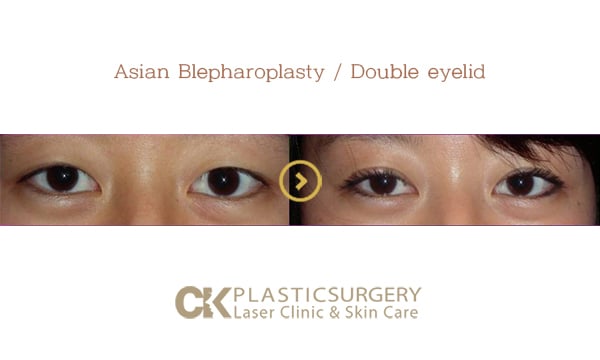 Before and after upper blepharoplasty in Los Angeles, showing removal of hooded eyelid skin for a more open eye