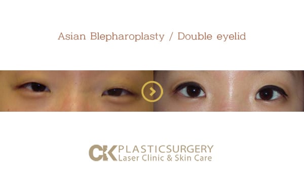 Patient's eyes before and after upper eyelid surgery for sagging skin in Southern California
