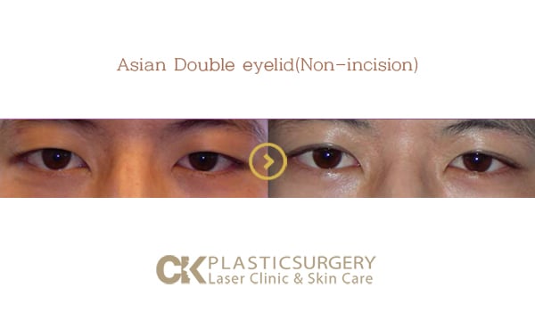Before and after upper blepharoplasty in Los Angeles, showing removal of hooded eyelid skin for a more open eye