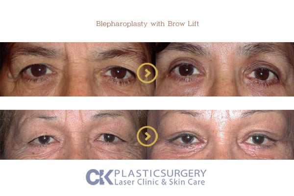 Before and after upper blepharoplasty in Los Angeles, showing removal of hooded eyelid skin for a more open eye