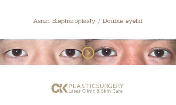 Patient's eyes before and after upper eyelid surgery for sagging skin in Southern California