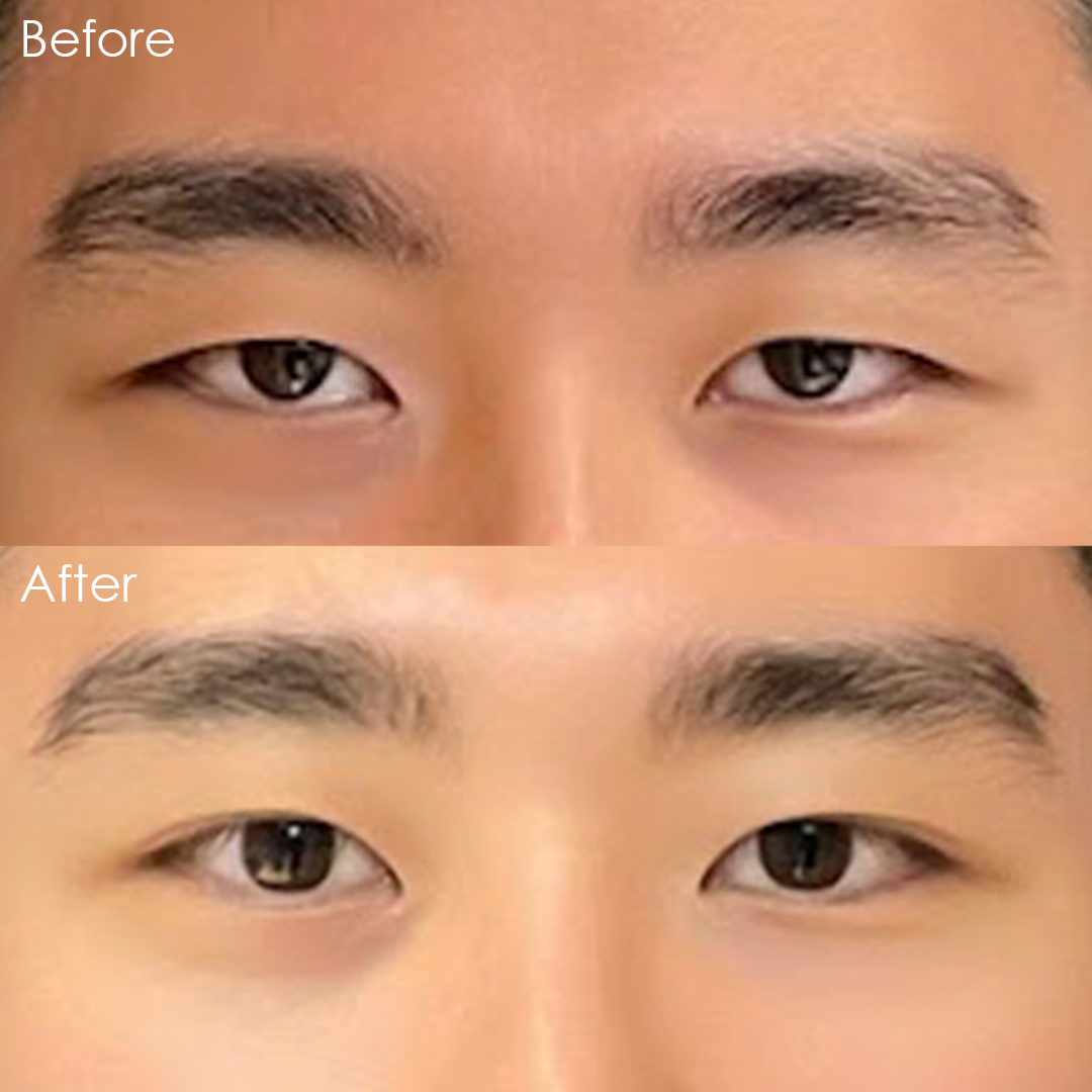 Before and after upper blepharoplasty in Los Angeles, showing removal of hooded eyelid skin for a more open eye