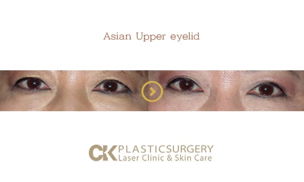Before and after upper blepharoplasty in Los Angeles, showing removal of hooded eyelid skin for a more open eye