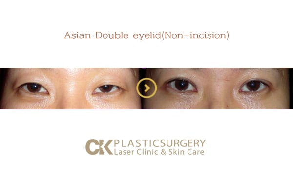Before and after upper blepharoplasty in Los Angeles, showing removal of hooded eyelid skin for a more open eye