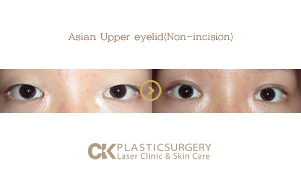 Before and after upper blepharoplasty in Los Angeles, showing removal of hooded eyelid skin for a more open eye