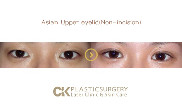 Before and after upper blepharoplasty in Los Angeles, showing removal of hooded eyelid skin for a more open eye